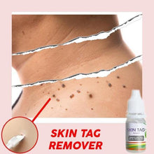 Load image into Gallery viewer, Skin Tag Remover
